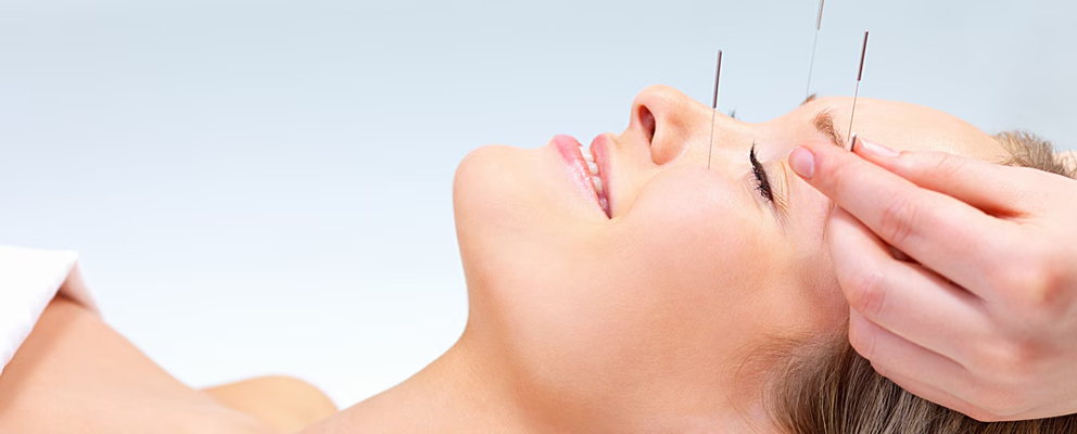 Acupuncture